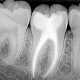 Tratamiento inmediato del dolor dental