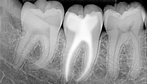 Tratamiento inmediato del dolor dental