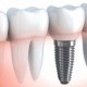 Implante dental unitario