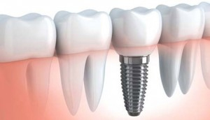 Implante dental unitario