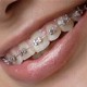 brackets de metal