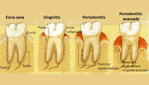 Periodontitis