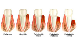 Tratamientos para Gingivitis y Periodontitis